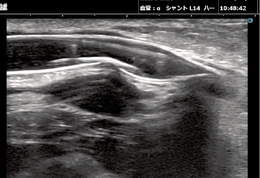 エコーを用いたバルーニング
